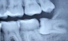diş röntgeni